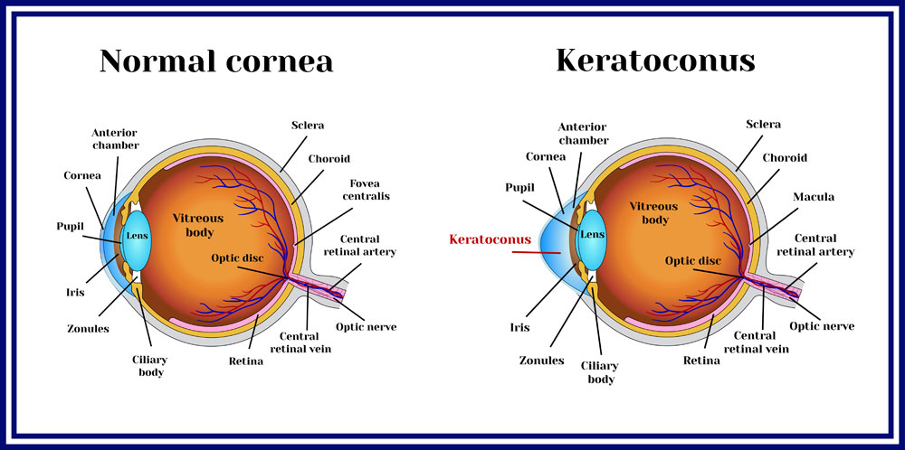 Keratoconus Care